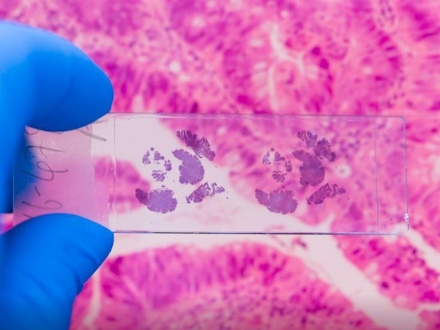 В Первоуральске онкологи подвели итоги прошлого года: выявлено 828 новых случаев